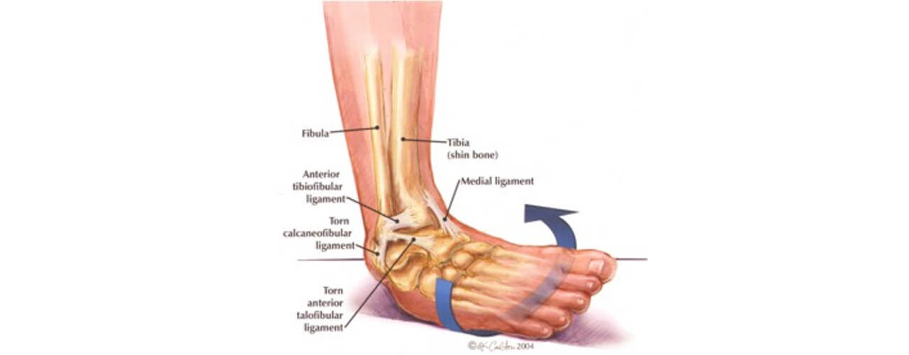 Lateral Ankle Sprains