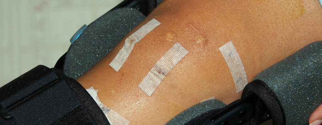 Joint Replacement: Before and After